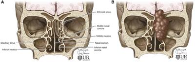 Radiologic overview of sinonasal lesions